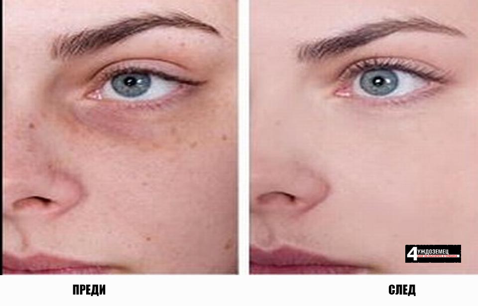 11 начина за премахване на черни точки и тъмни петна по лицето